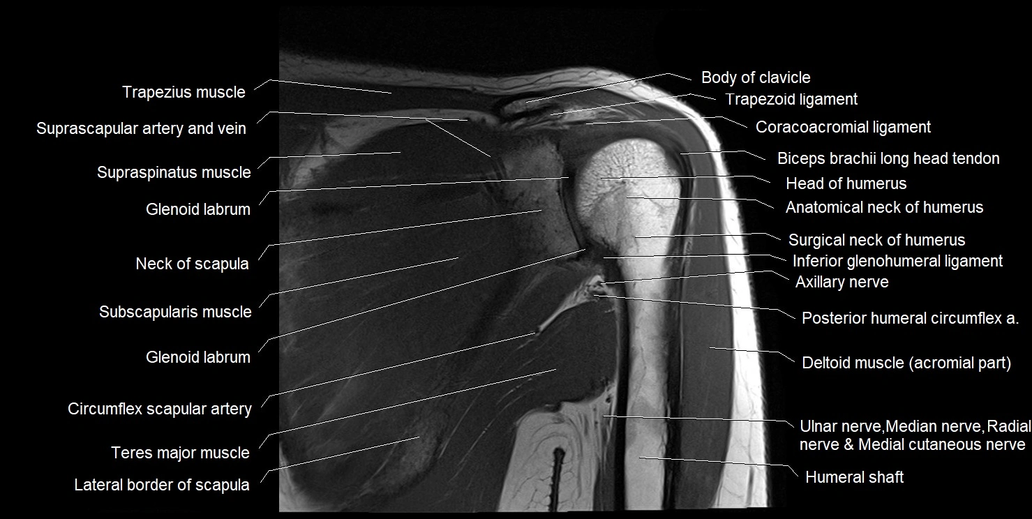 mri shoulder coronal cross sectional anatomy image 9.webp